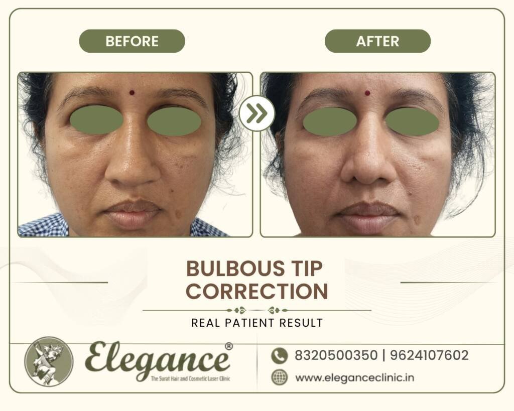 Bulbous-Tip-Reshaping