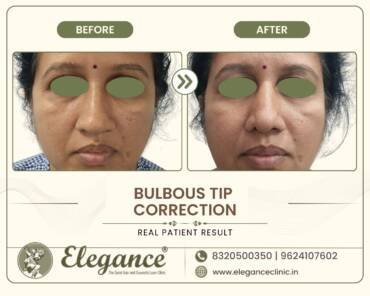 Bulbous-Tip-Reshaping