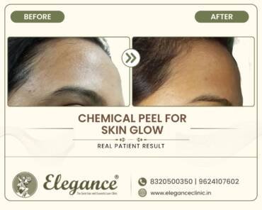 Chemical-Peel-Skin-Glow