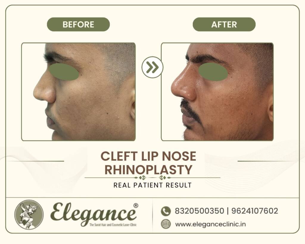Cleft-Lip-Nasal-Correction