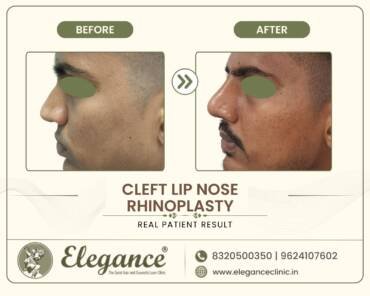 Cleft-Lip-Nasal-Correction