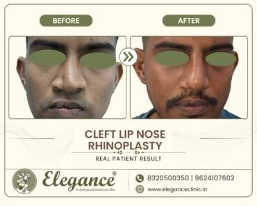 Cleft-Lip-Nose-Rhinoplasty-Front