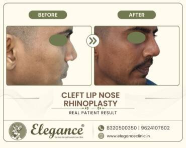 Cleft-Nasal-Deformity-Correction