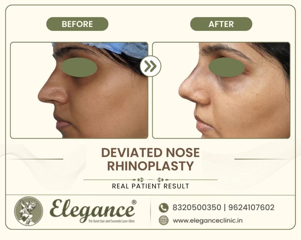 Crooked-Nose-Correction