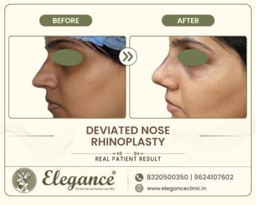 Crooked-Nose-Correction