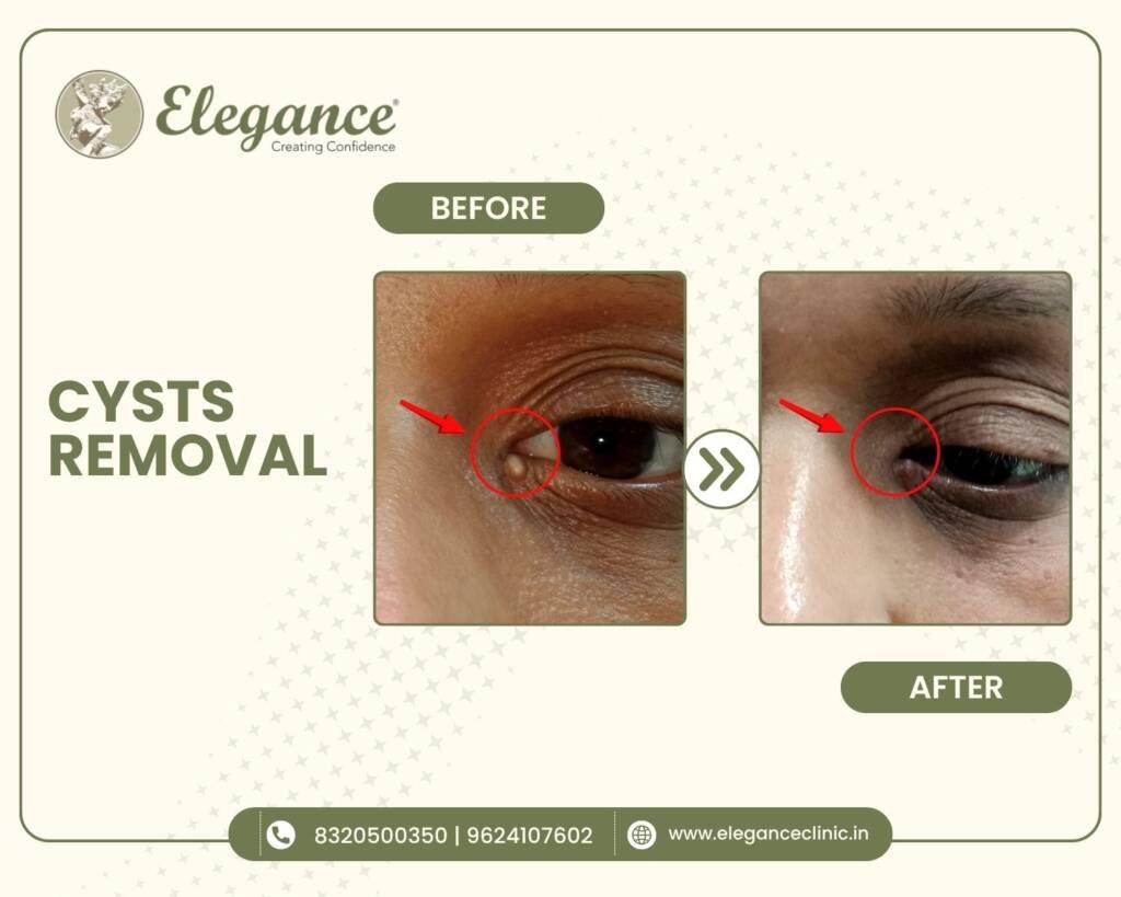 Cyst-Removal