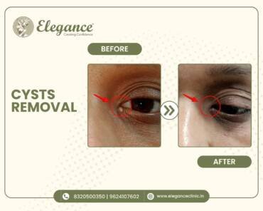 Cyst-Removal
