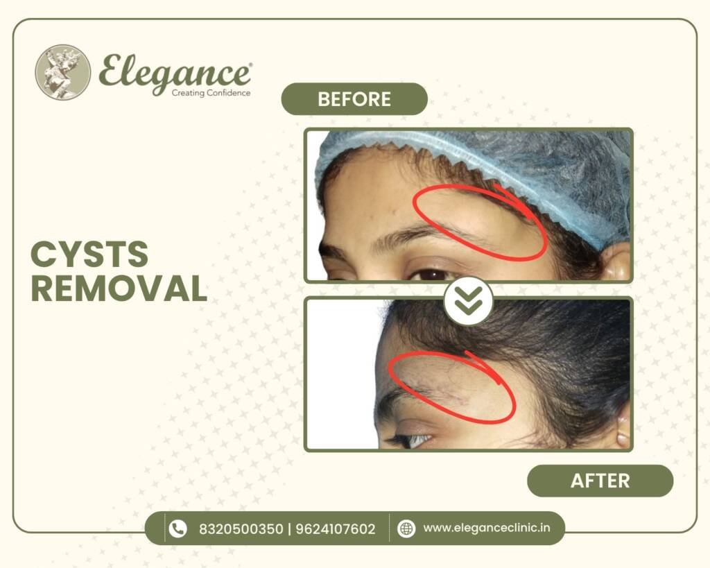 Cyst-Removal-Forehead