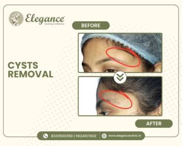 Cyst-Removal-Forehead
