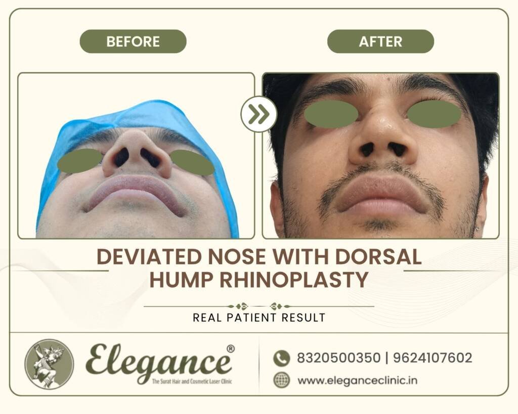 Deviated-Nose-Dorsal-Hump-Rhinoplasty