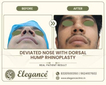 Deviated-Nose-Dorsal-Hump-Rhinoplasty