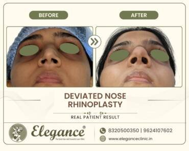 Deviated-Nose-Rhinoplasty (2)