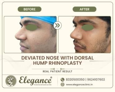 Deviated-Nose-Rhinoplasty