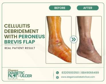Diabetic foot clinic
