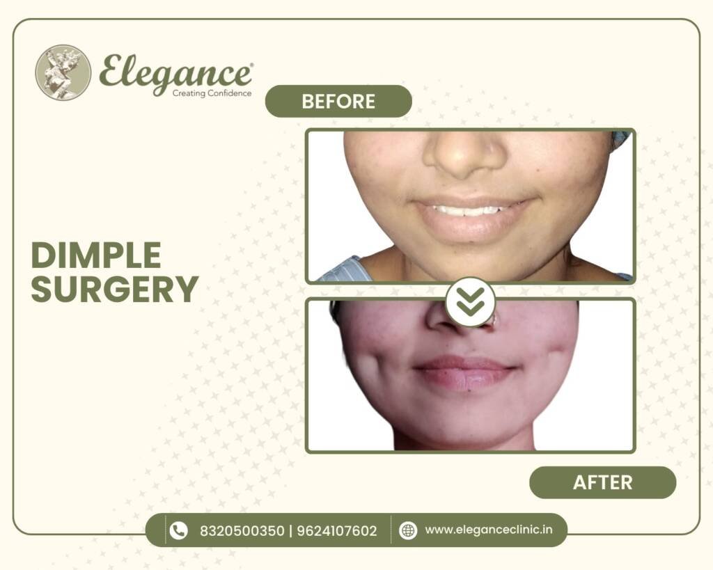 Dimple-Surgery
