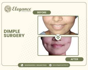 Dimple-Surgery