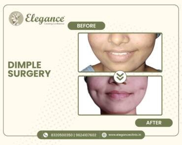 Dimple-Surgery
