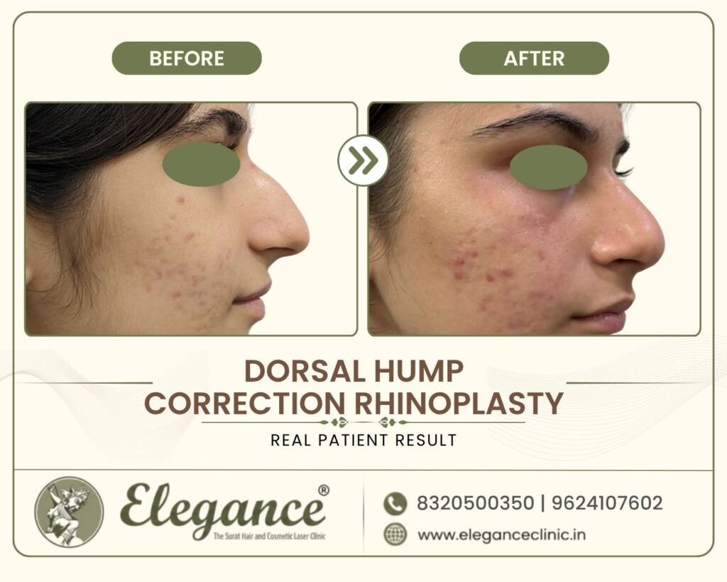Dorsal-Hump-Correction