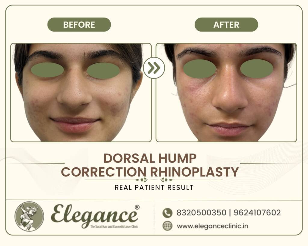 Dorsal-Hump-Correction-Rhinoplasty-Front