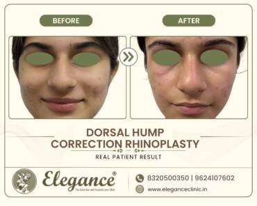 Dorsal-Hump-Correction-Rhinoplasty-Front