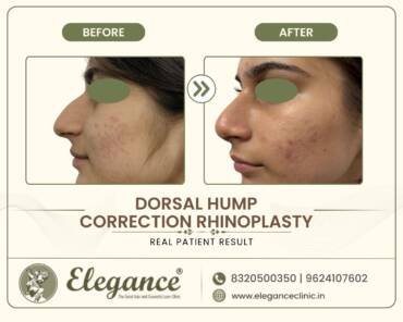 Dorsal-Hump-Correction-Rhinoplasty-Profile