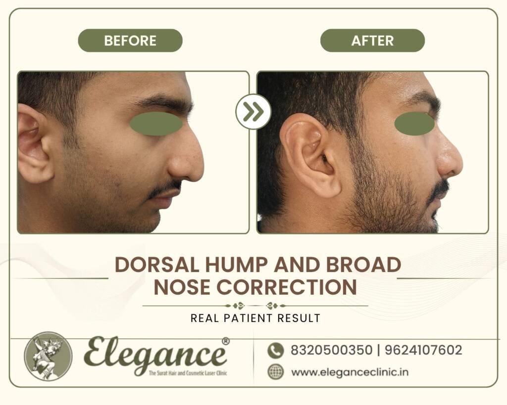 Dorsal-Hump-Reduction