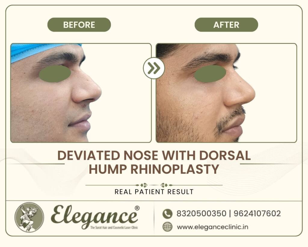 Dorsal-Hump-Rhinoplasty