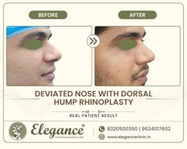 Dorsal-Hump-Rhinoplasty