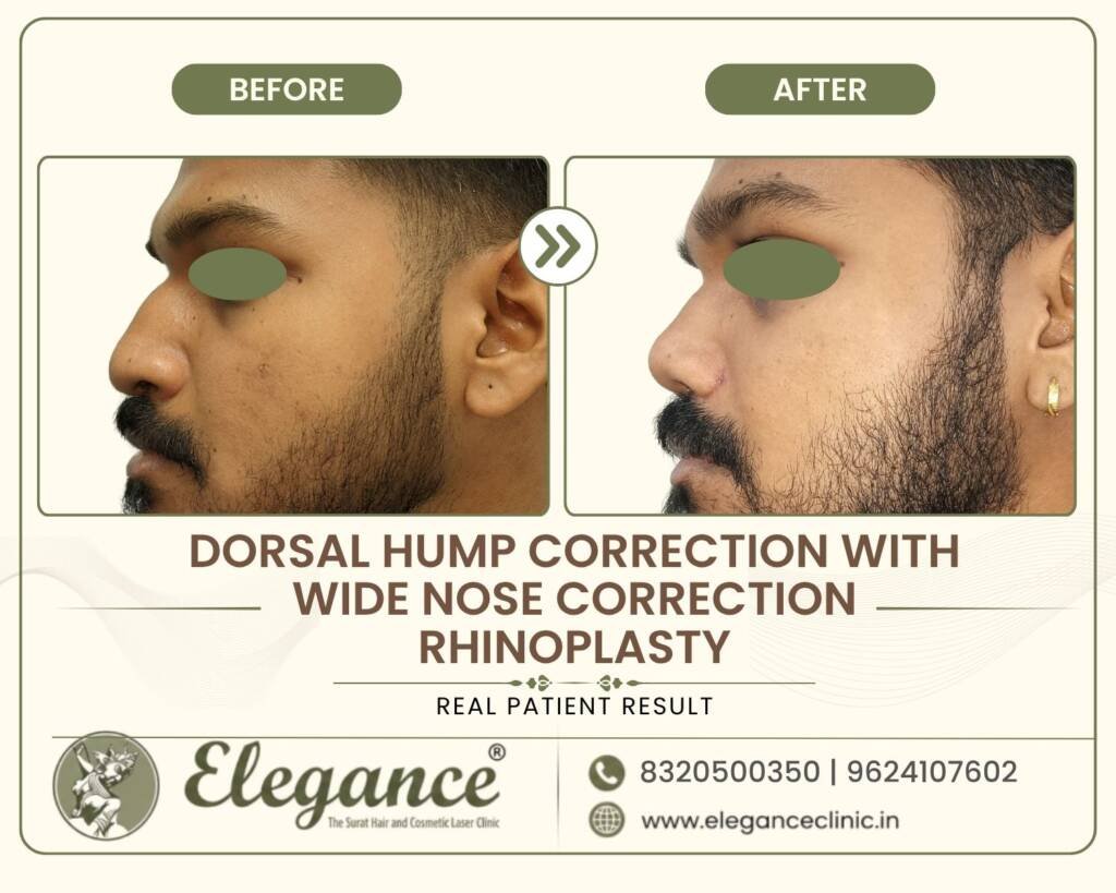 Dorsal-Hump-Wide-Nose-Rhinoplasty