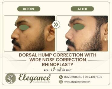 Dorsal-Hump-Wide-Nose-Rhinoplasty