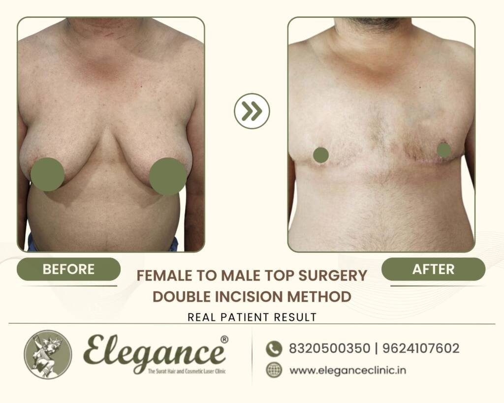 Double-Incision-Chest-Masculinization