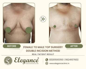 Double-Incision-Chest-Masculinization