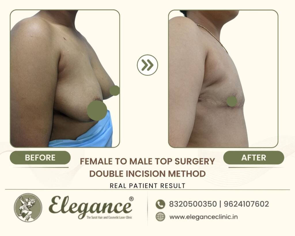 Double-Incision-Top-Surgery