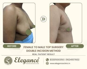 Double-Incision-Top-Surgery