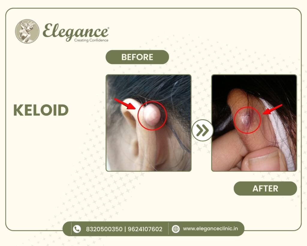 Ear-Keloid-Treatment