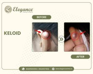 Ear-Keloid-Treatment