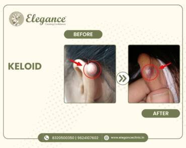 Ear-Keloid-Treatment