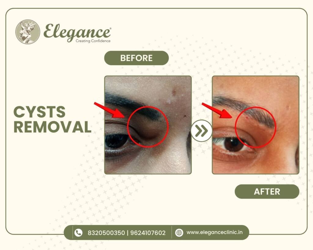 Eyelid-Cyst-Removal