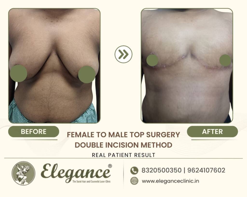FTM-Top-Surgery-Double-Incision