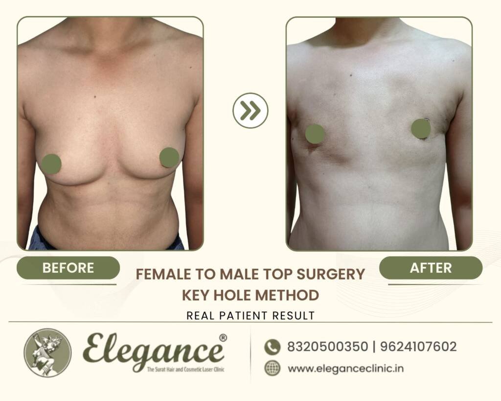 FTM-Top-Surgery-Keyhole