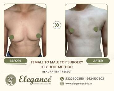FTM-Top-Surgery-Keyhole