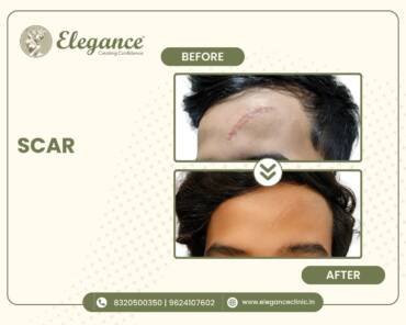 Forehead-Scar-Treatment
