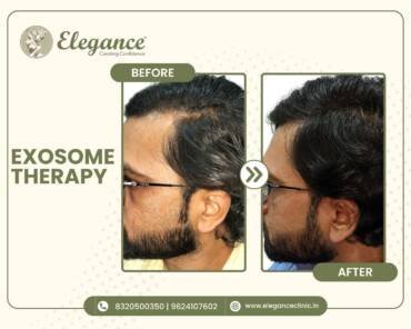 HairThinning Hair Treatment