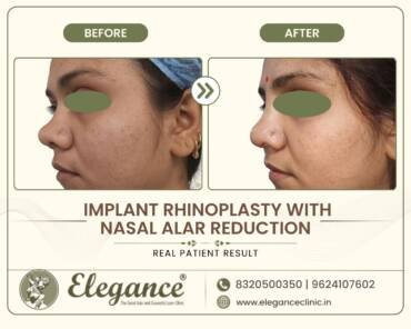 Implant-Rhinoplasty-Alar-Reduction