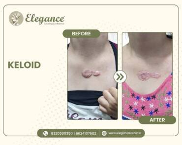 Keloid