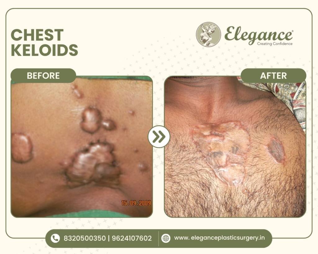 Keloid ear
