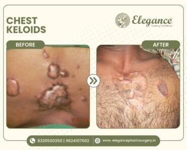 Keloid ear