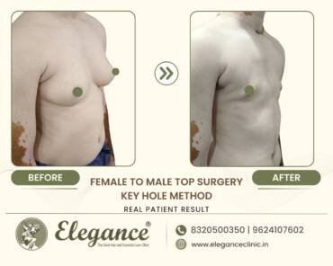 Keyhole-Chest-Masculinization