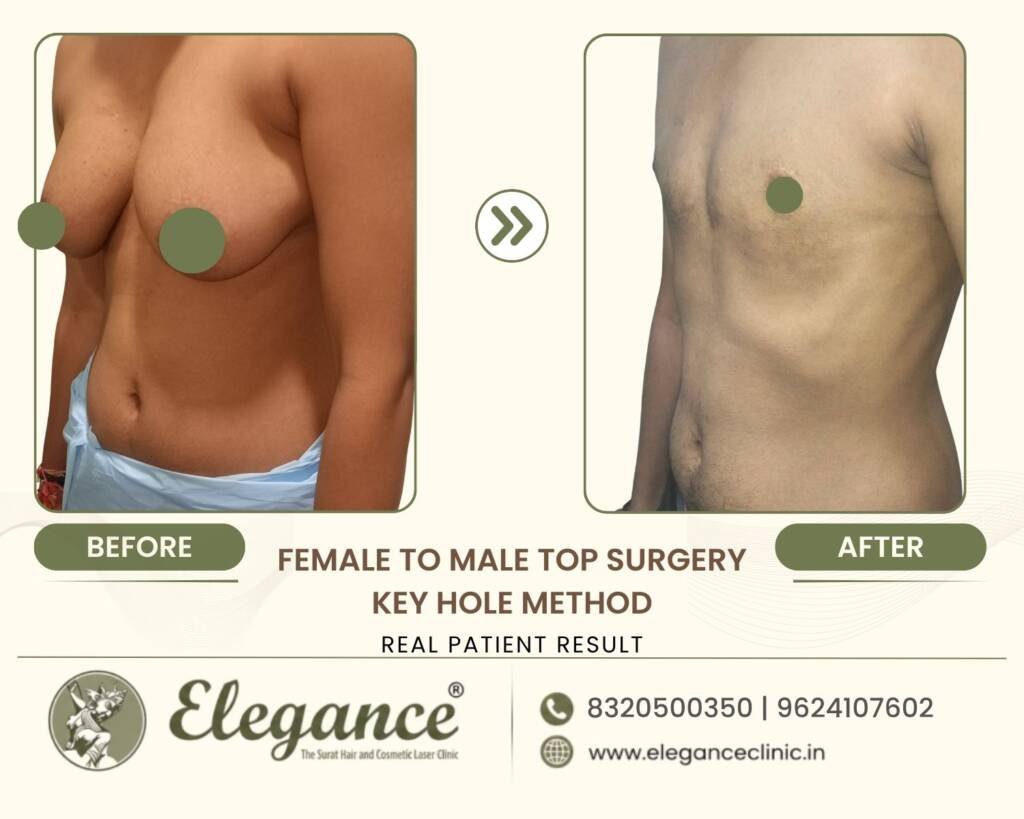 Keyhole-Gender-Affirming-Top-Surgery