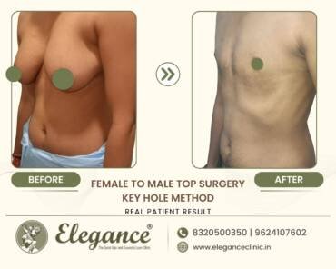 Keyhole-Gender-Affirming-Top-Surgery